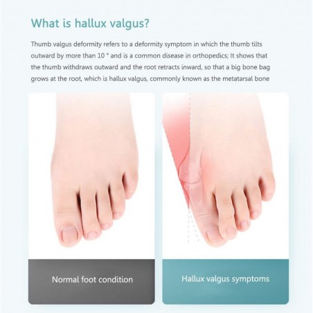 WIDEWINGS Bunion Splint, Toe straightener bunion corrector for women & men splint with toe fracture support and foot support for